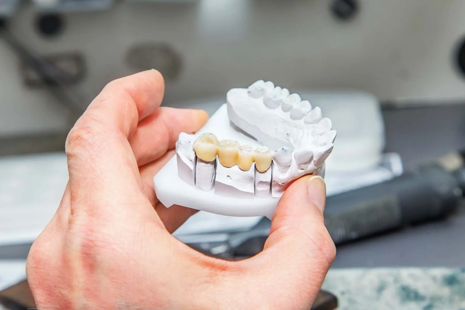 Dental bridges