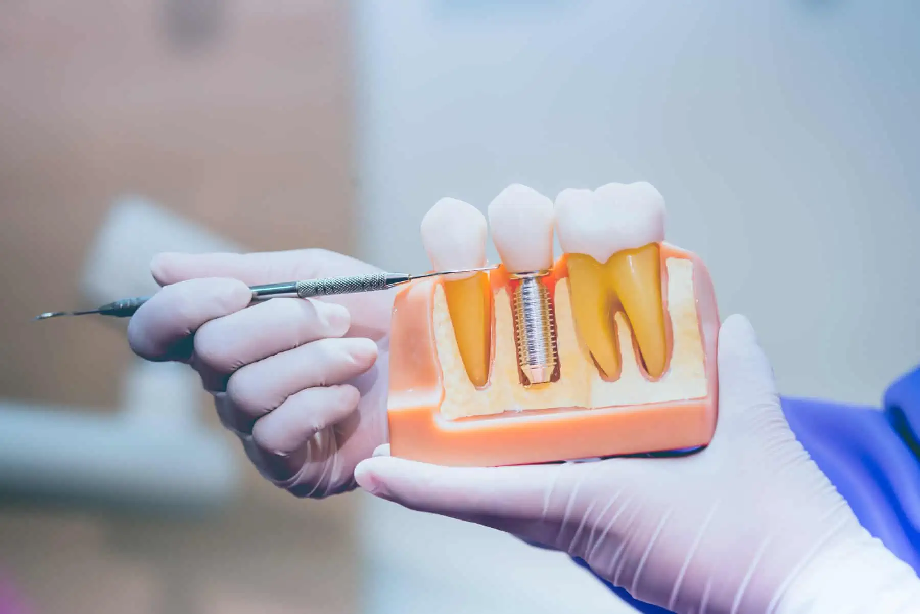 Dental implants in Orange, CA