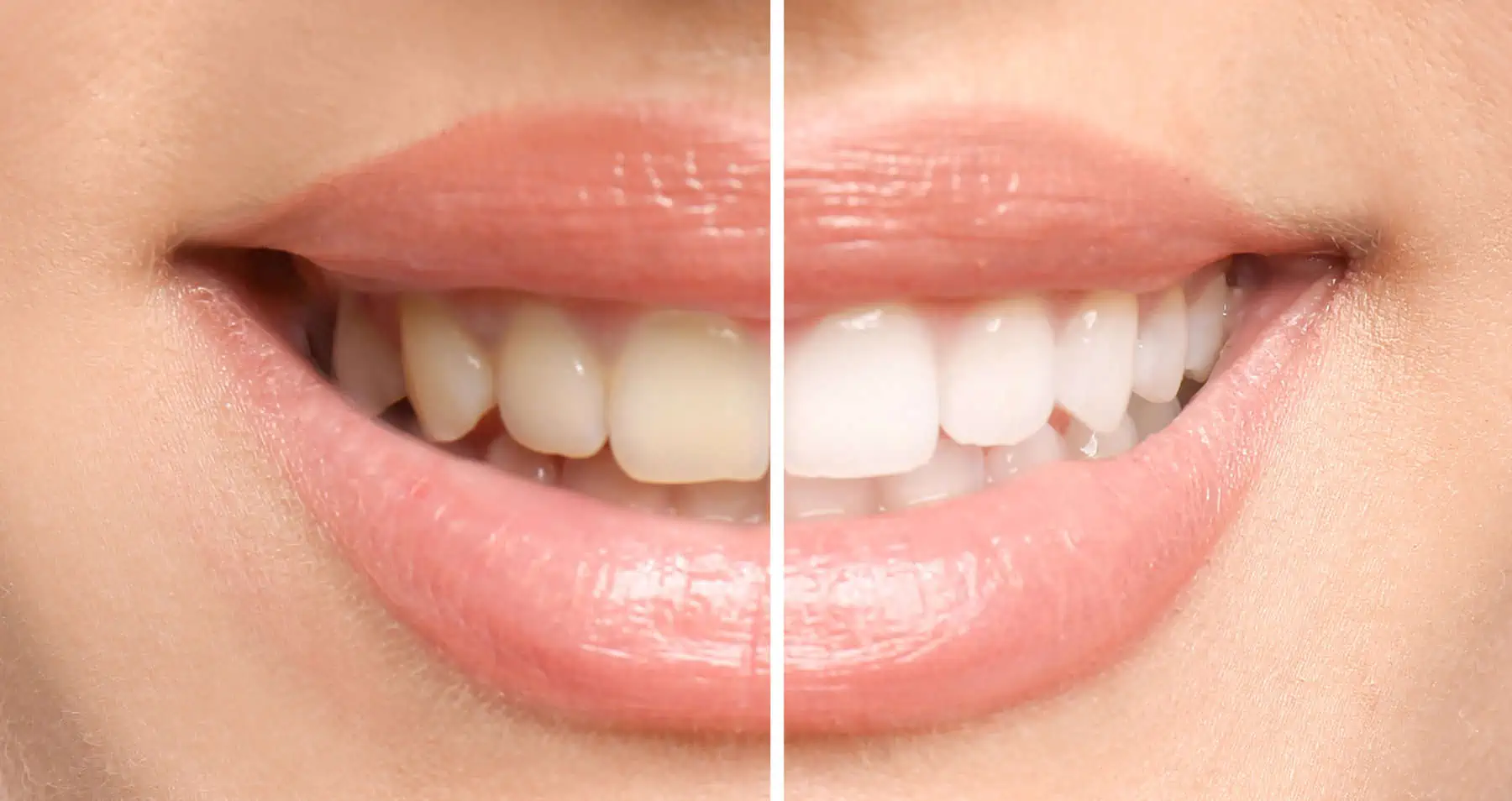 Professional teeth whitening at Glassell Dental in Orange, CA