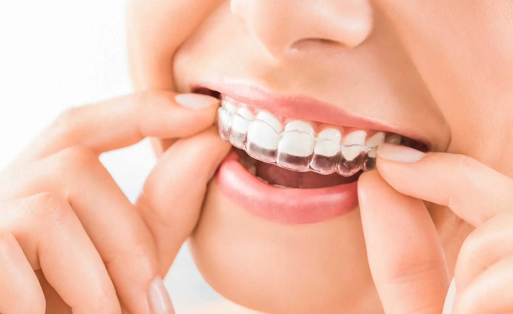 Invisalign & Clear Aligner Therapy