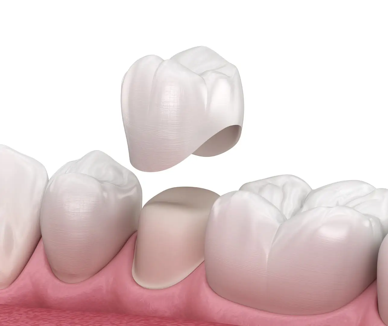 Dental crown treatment at Glassell Dental in Orange, CA